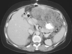 Gastric Leiomyosarcoma - CTisus CT Scan