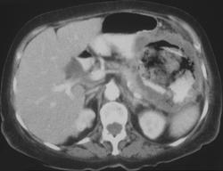 Ulcerating Colon Cancer With Colo-gastric Fistulae - CTisus CT Scan