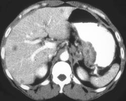 Gastric Adenocarcinoma - CTisus CT Scan