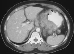 Gastric Adenocarcinoma With Adenopathy - CTisus CT Scan