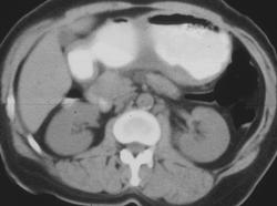 H. Pylori Simulates Gastric Cancer - CTisus CT Scan