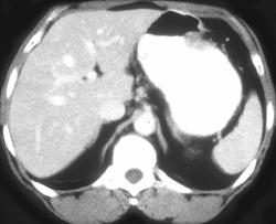 Polypoid Gastric Cancer - CTisus CT Scan