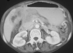 Gastric Adenocarcinoma With Gastric Outlet Obstruction - CTisus CT Scan