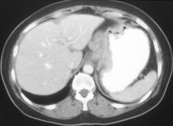 Gastric Cancer With Celiac Nodes - CTisus CT Scan