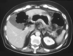 Infiltrating Gastric Cancer - CTisus CT Scan