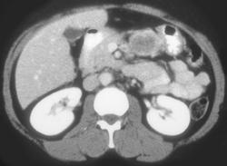 Gastric Leiomyoma - CTisus CT Scan