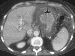 Severe Gastritis and Portal Vein Thrombosis - CTisus CT Scan