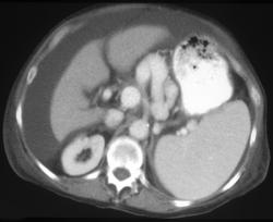 Gastric Varices - CTisus CT Scan