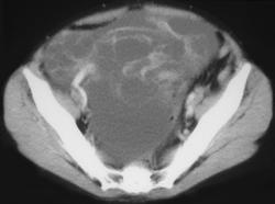 Kruckenberg Tumor Secondary to Gastric Primary - CTisus CT Scan