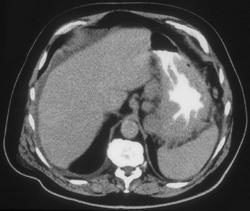 Gastric Lymphoma - CTisus CT Scan