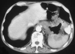 Gastric Lymphoma With Adrenal Involvement - CTisus CT Scan