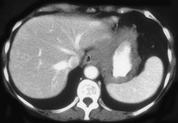 Gastric Lymphoma - CTisus CT Scan