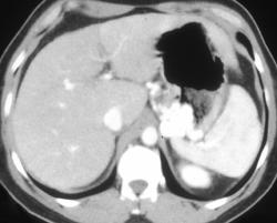 Gastric Varices - CTisus CT Scan