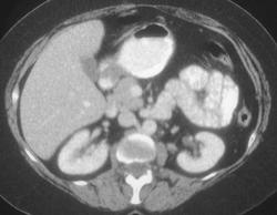 Gastric Leiomyoma - CTisus CT Scan