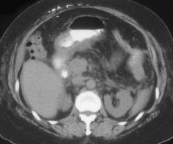 Eosinophilic Gastritis - CTisus CT Scan