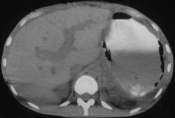 Emphysematous Gastritis - CTisus CT Scan