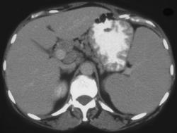 Gastric Lymphoma - CTisus CT Scan