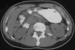 Gastric Ulcer in Adenocarcinoma - CTisus CT Scan