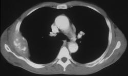 Bone Mets From Gastric Cancer - CTisus CT Scan