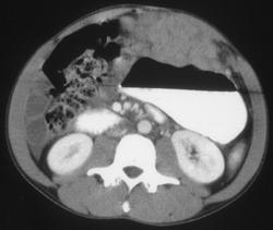 Leiomyosarcoma - CTisus CT Scan