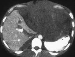 Gastric Leiomyosarcoma - CTisus CT Scan