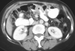 Recurrent Gastric Cancer at Anastomosis - CTisus CT Scan