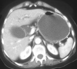 Gastric Outlet Obstruction Due to Antral Cancer - CTisus CT Scan