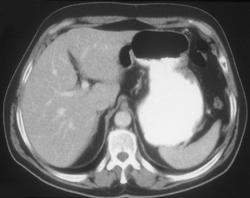 Gastric Adenocarcinoma - CTisus CT Scan