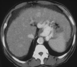 Gastric Varices and Cirrhosis - CTisus CT Scan