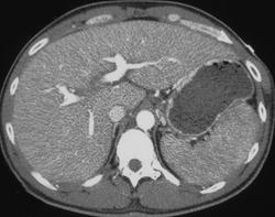 Normal Stomach - CTisus CT Scan