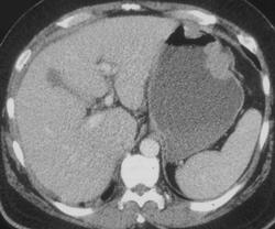 Gastric Lymphoma (unusual) - CTisus CT Scan