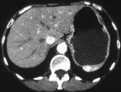 Normal Stomach - CTisus CT Scan