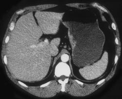 Subtle Gastric Cancer - CTisus CT Scan