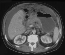 Antral Carcinoma With Carcinomatosis - CTisus CT Scan