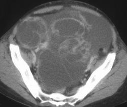 Gastric Cancer With Kruckenberg Tumor - CTisus CT Scan