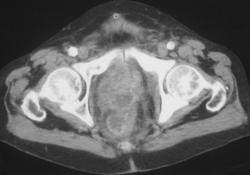 Drop Mets on Rectum From A Gastric Primary - CTisus CT Scan