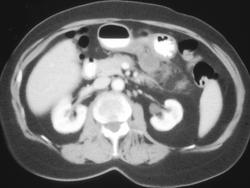 Perforated Gastric Ulcer - CTisus CT Scan