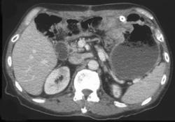 Recurrence Gastric Cancer at Anastomosis - CTisus CT Scan