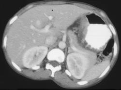 Ulcer in Gastric Adenocarcinoma - CTisus CT Scan