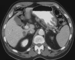 Gastric Lymphoma - CTisus CT Scan