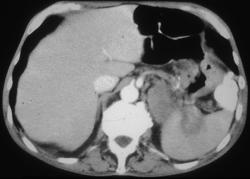 Gastric Lymphoma - CTisus CT Scan