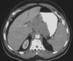 Gastric Lymphoma - CTisus CT Scan