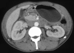 Gastric Outlet Obstruction Due to Carcinoma - CTisus CT Scan