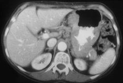 Gastric Lymphoma - CTisus CT Scan