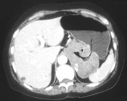 Gastric Leiomyosarcoma - CTisus CT Scan