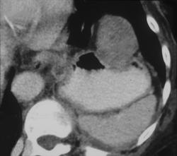 Gastric Leiomyosarcoma - CTisus CT Scan