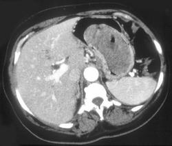 Gastric Leiomyosarcoma - CTisus CT Scan