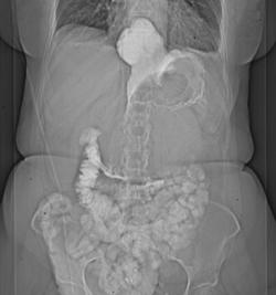 Metastatic Ovarian Cancer With Implants on Stomach - CTisus CT Scan