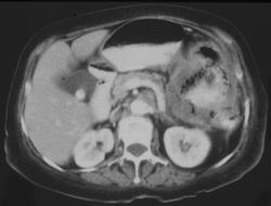 Gastrocolic Fistulae Due to Colon Cancer (simulates Gastric Leiomyosarcoma) - CTisus CT Scan