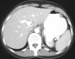 Melanoma Metastatic to the Stomach - CTisus CT Scan